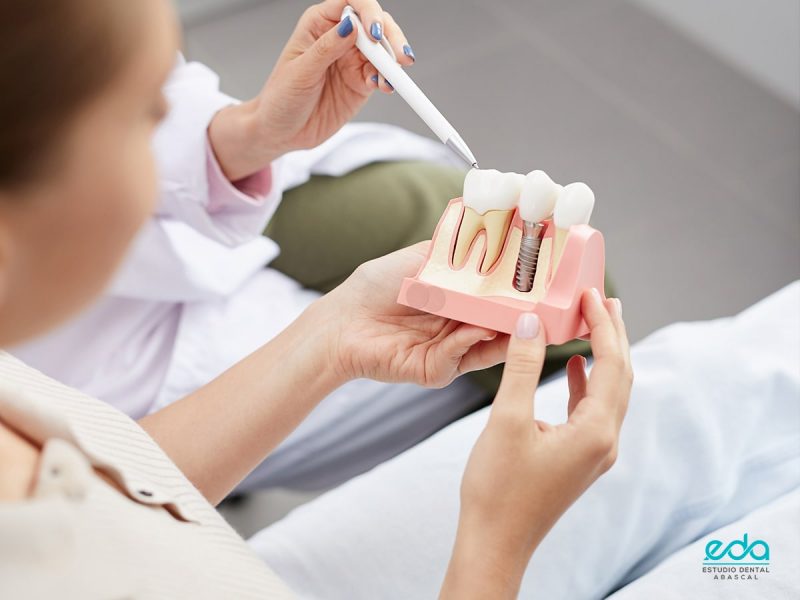 Beneficios De La Implantolog A Dental Eda Cl Nica Dental