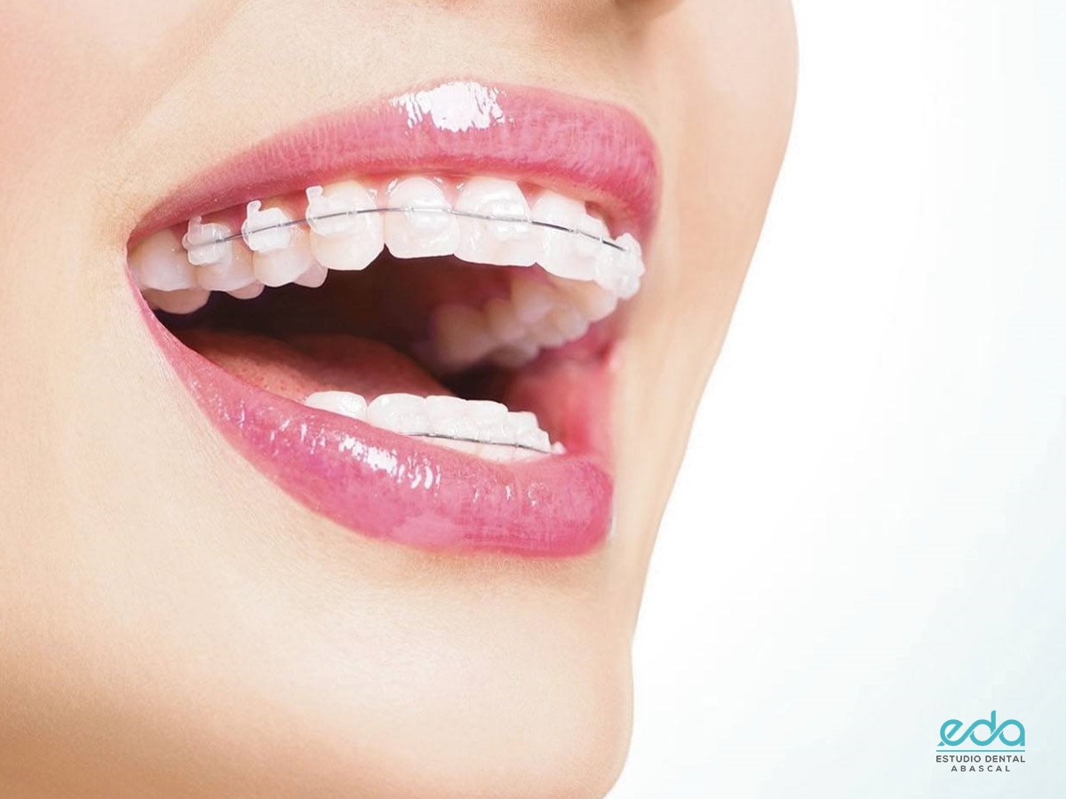 Ortodoncia: motivos para utilizarla