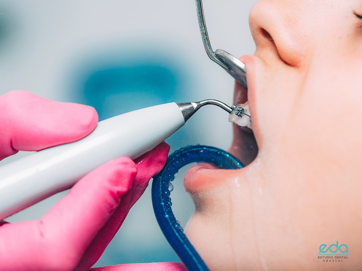 Limpieza dental: ¡conoce sus beneficios! - EDA Dental