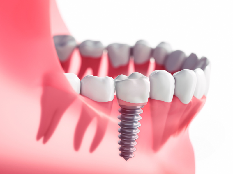 Implantes dentales