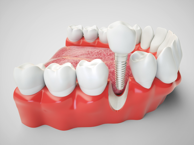 implantes inmediatos en Chamberí