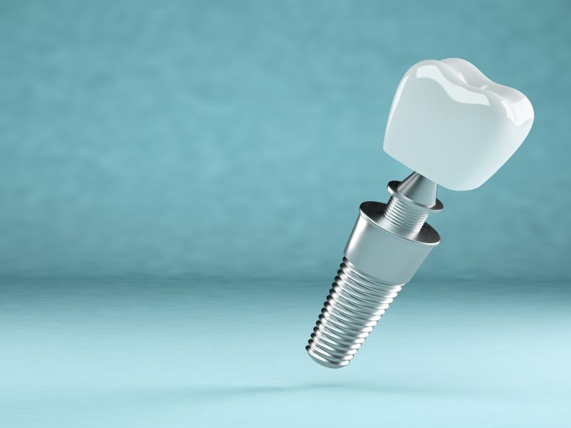 7 mitos sobre implantes dentales