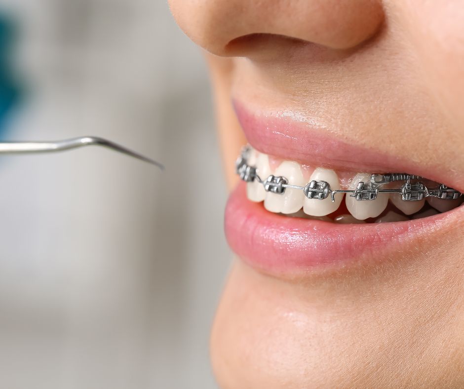 Brackets contra Invisalign