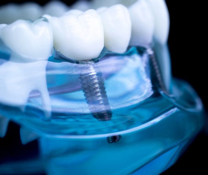 Cómo Cuidar Los Implantes Dentales: Sonrisa Restaurada