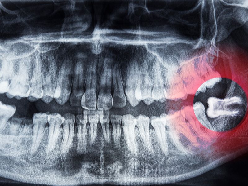 cirugía maxilofacial para muela del juicio